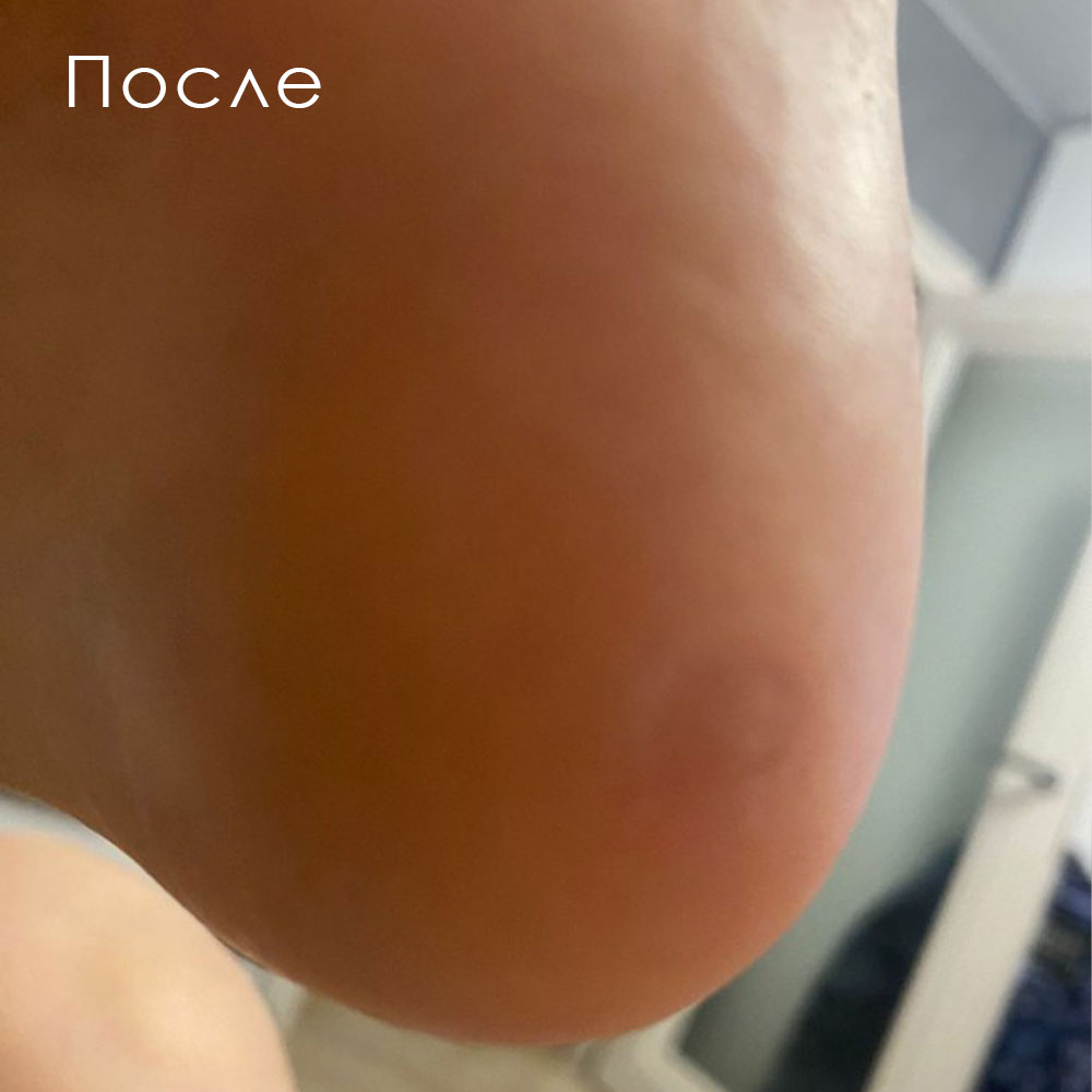 Бальзам для кожи ног Verrugal Oil, 15мл - 2