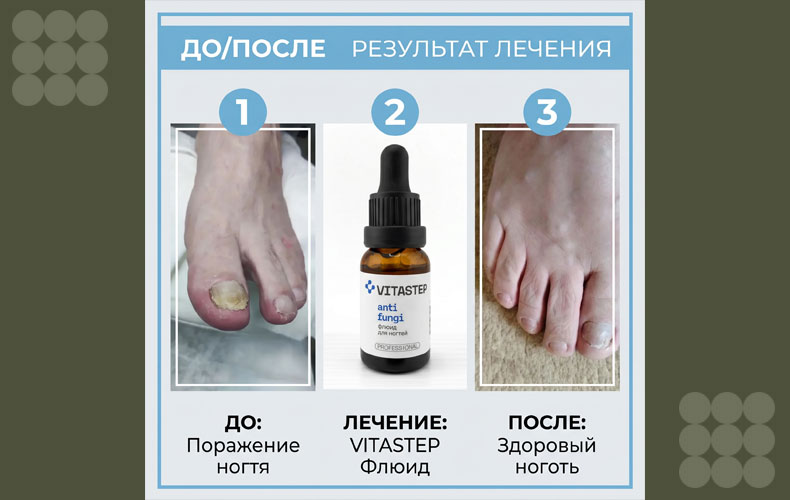 Реальный кейс: как AntiFungi Флюид помог справиться с грибком ногтей